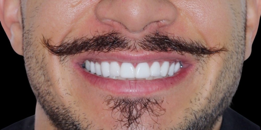 Antes do tratamento — Lentes de Contato Dental