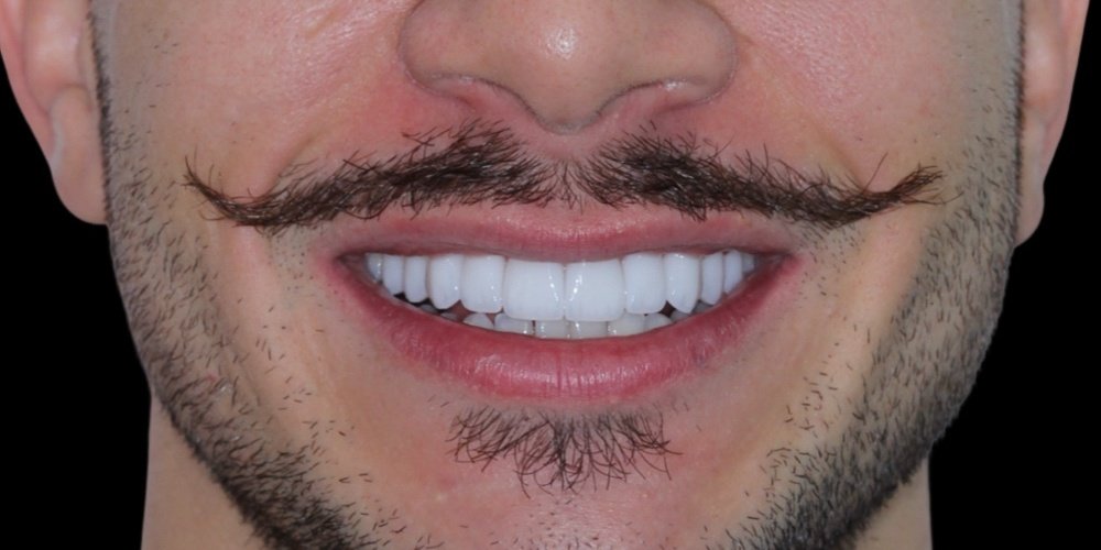 Depois do tratamento — Lentes de Contato Dental