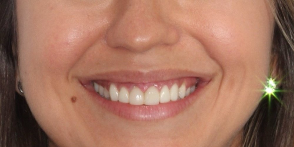 Antes do tratamento — Lentes de Contato Dental