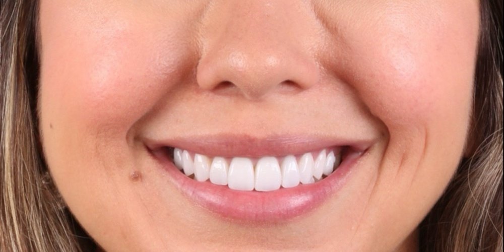 Depois do tratamento — Lentes de Contato Dental