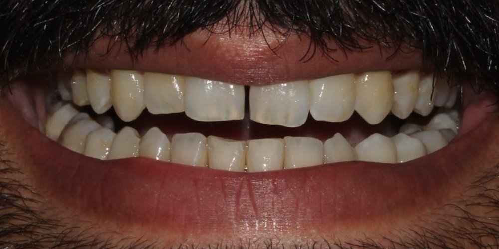 Antes do tratamento — Lentes de Contato Dental