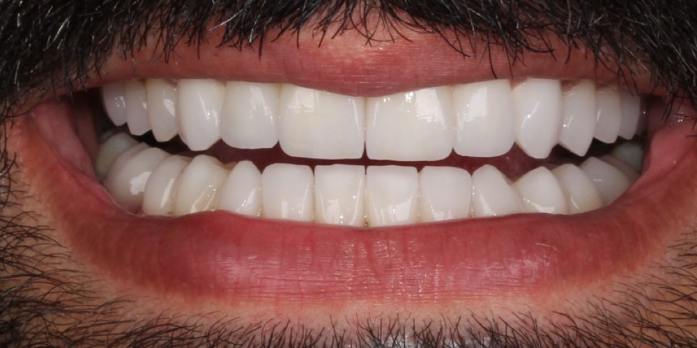 Depois do tratamento — Lentes de Contato Dental