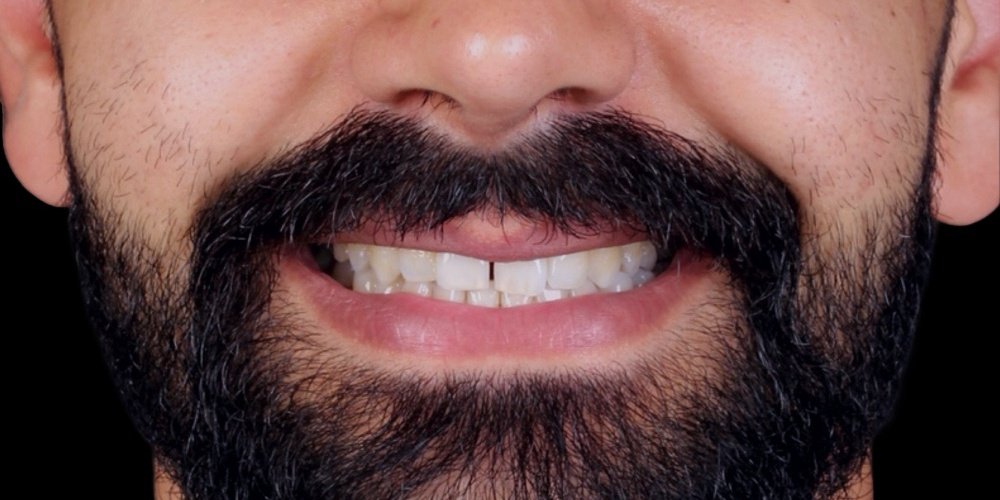 Antes do tratamento — Lentes de Contato Dental