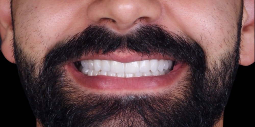 Depois do tratamento — Lentes de Contato Dental
