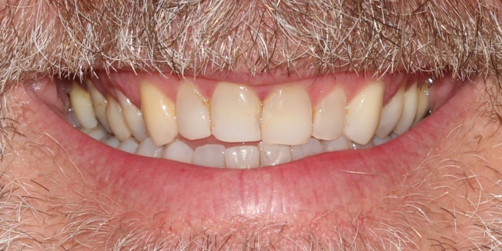 Antes do tratamento — Lentes de Contato Dental