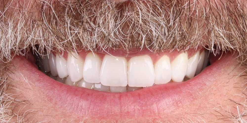 Depois do tratamento — Lentes de Contato Dental