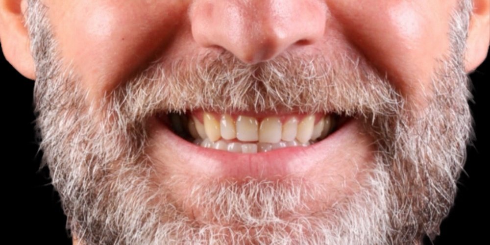 Antes do tratamento — Lentes de Contato Dental
