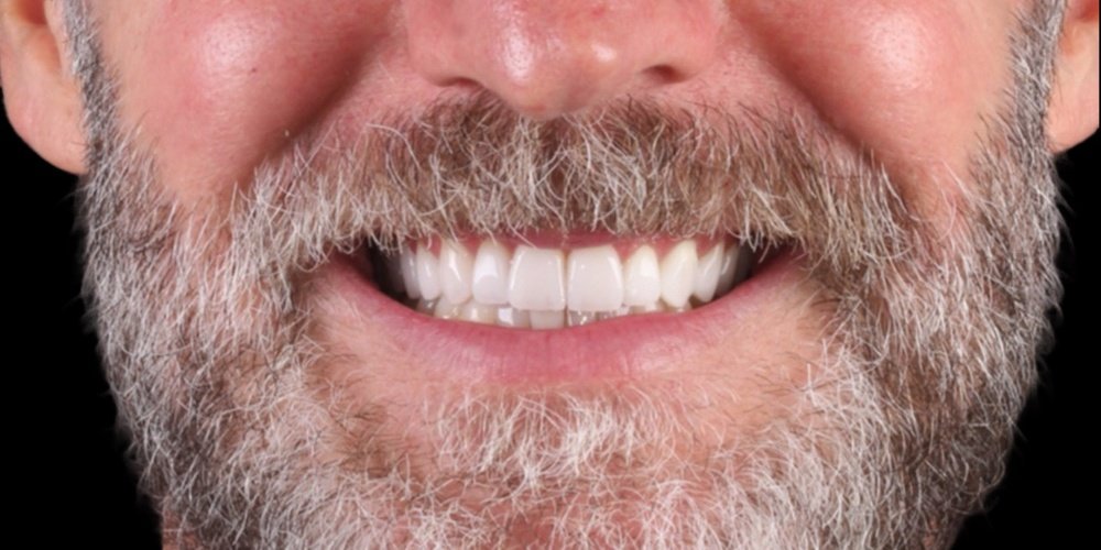 Depois do tratamento — Lentes de Contato Dental