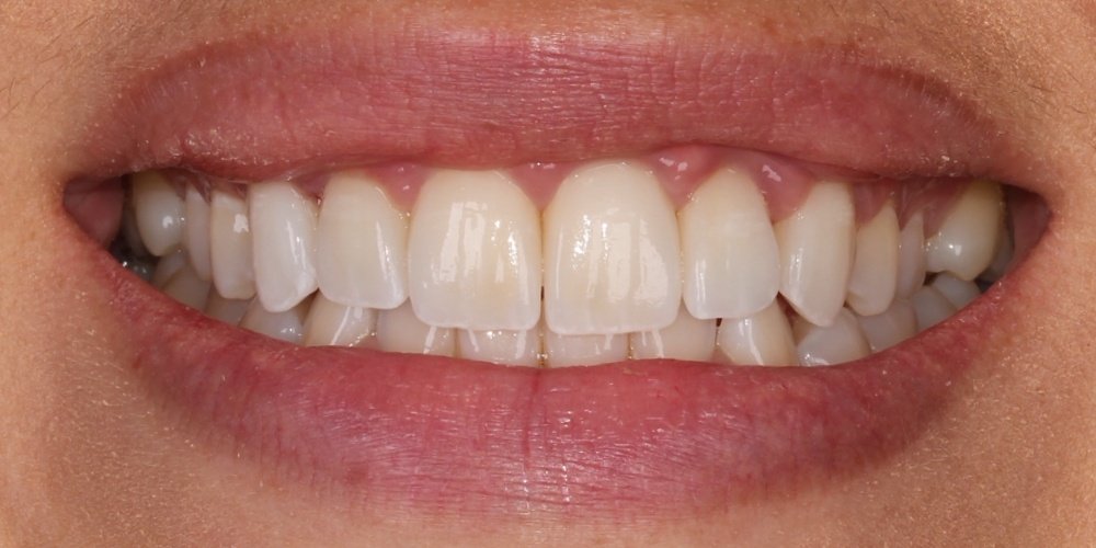 Antes do tratamento — Lentes de Contato Dental