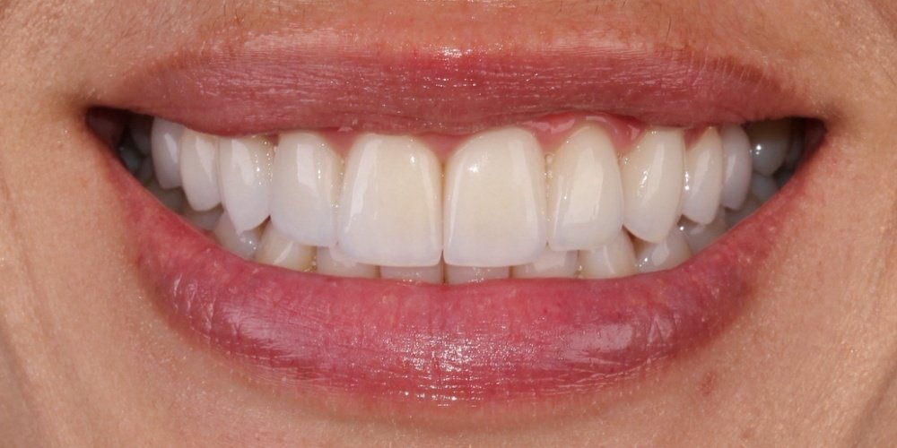 Depois do tratamento — Lentes de Contato Dental