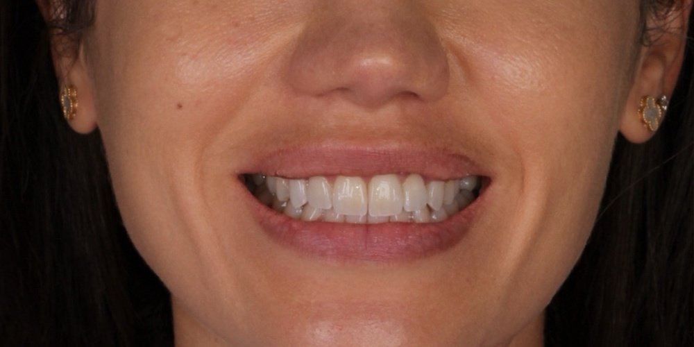 Antes do tratamento — Lentes de Contato Dental