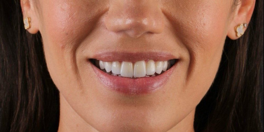 Depois do tratamento — Lentes de Contato Dental