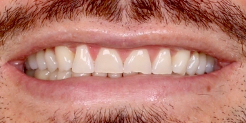 Antes do tratamento — Lentes de Contato Dental