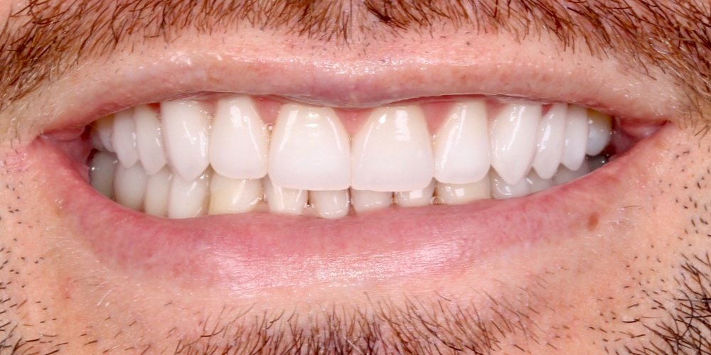 Depois do tratamento — Lentes de Contato Dental