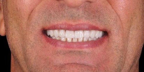 Depois do tratamento — Reabilitação Oral