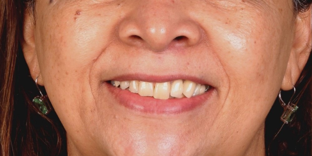 Antes do tratamento — Reabilitação Oral