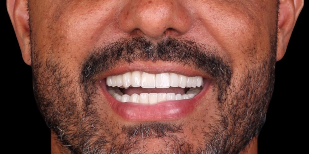 Depois do tratamento — Reabilitação Oral
