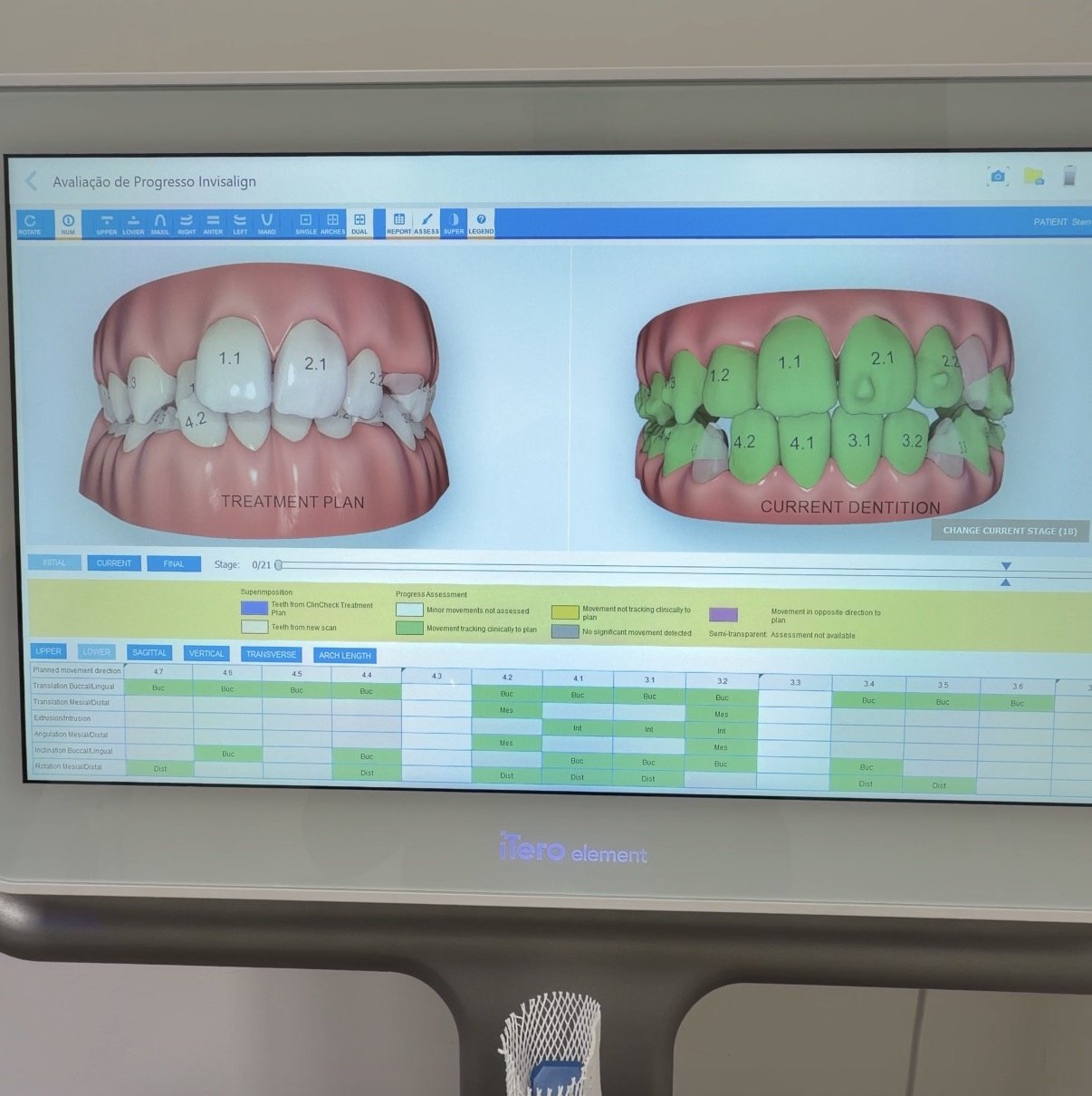 Tela do iTero mostrando o planejamento digital do movimento dos dentes